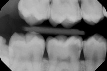 Digital X-Rays