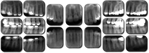 Digital X-Rays Full Mouth